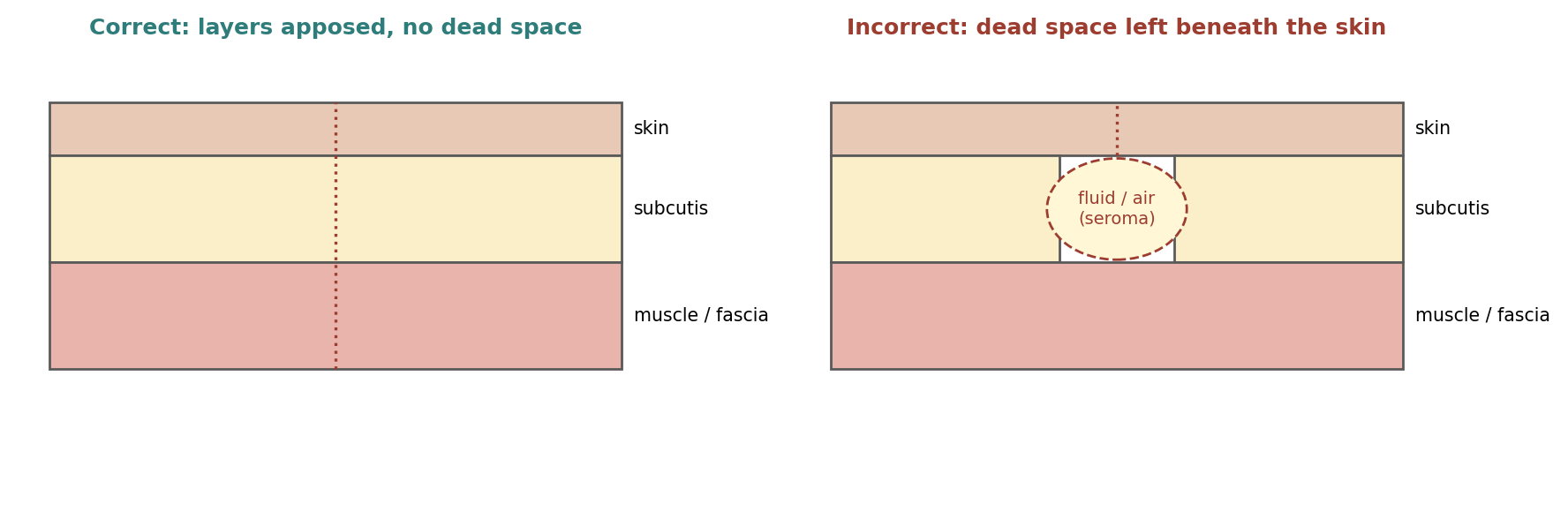 Layered closure that eliminates dead space, compared with a closure that leaves dead space beneath the skin (schematic).