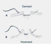 Vertical mattress: correct apposition (A) versus excessive eversion (B)