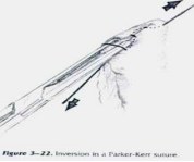 Parker-Kerr: inversion with the second (Lembert) layer