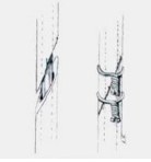 Cerclage Wiring