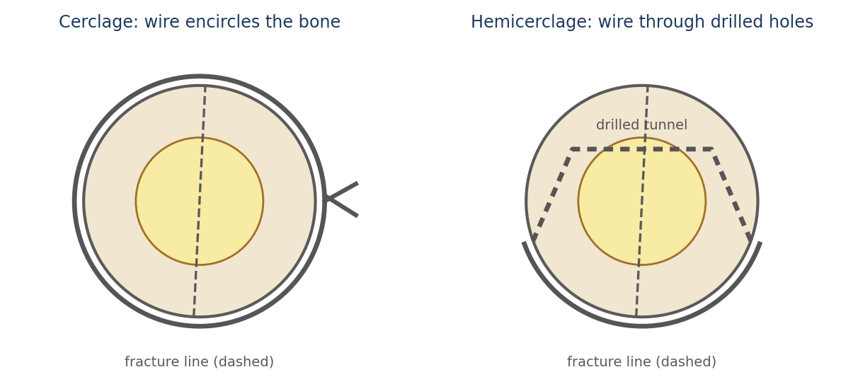 Cerclage (left) and hemicerclage (right), cross-sections (schematic)
