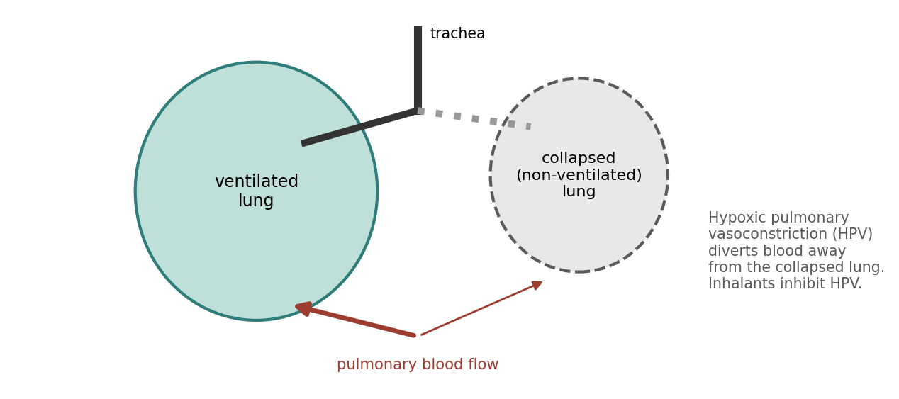 One-lung ventilation and hypoxic pulmonary vasoconstriction (schematic).