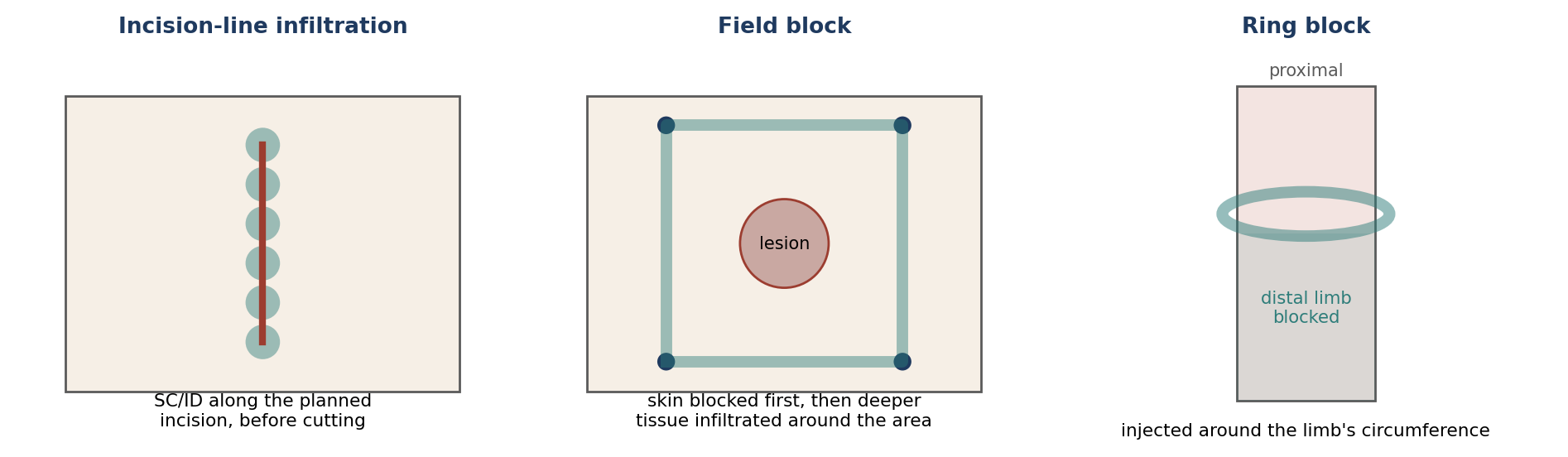 Patterns of local infiltration: incision-line infiltration, field block, and ring block.