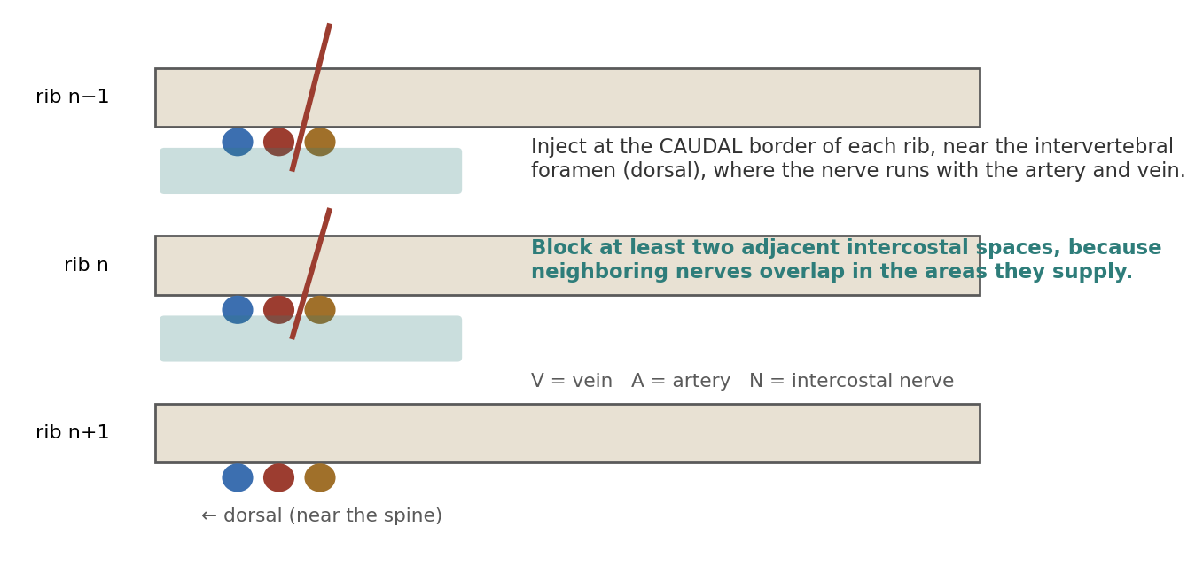 Intercostal nerve block. The nerve, artery, and vein run along the caudal border of each rib.