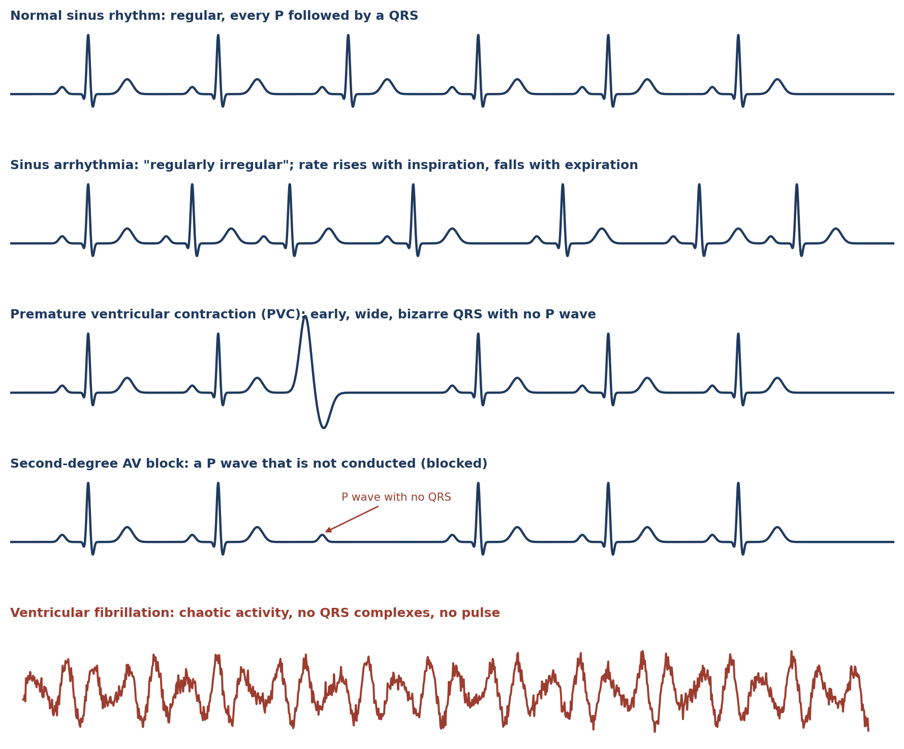 Representative ECG rhythm strips (schematic).